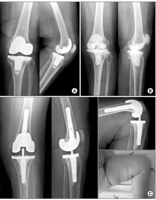 Fig.  2.  This  68  year-old  woman  visited our clinic with infection of left  total  knee  arthroplasty  that  was  done  in  other  hospital  4  months  ago  (A)