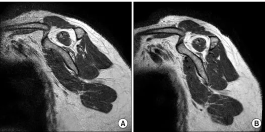 Fig.  1.  Regressed  fatty  dege- dege-neration  of  the  infraspinatus  in  63-years  old  woman