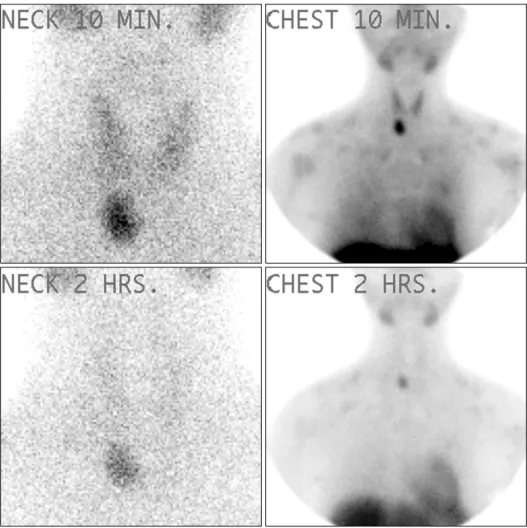 Fig.  4.  Parathyroid  scan  show- show-ing  hot  uptake  on  right  lower  parathyroid  gland.