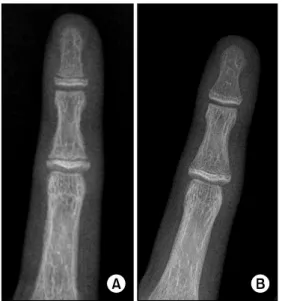 Fig.  7.  (A)  The  subperiosteal  resorptions  of  phalanges  were  shown preoperatively