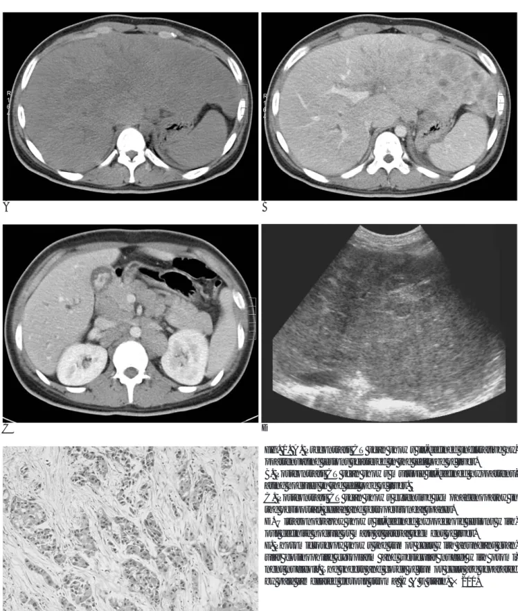 Fig. 1. A. Precontrast CT scan shows ill-defined infiltrative hy- hy-poattenuating lesions scattered in the left lobe of liver.