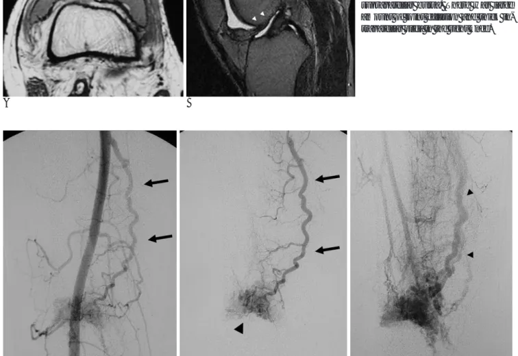 Fig. 5. Axial T1 weighted SE image (A) (TR/TE, 700/12) and T2 weighted  spin-echo image (B) (TR/TE, 2000/20, 2000/80) shows numerous signal voids (arrows) in the suprapatellar fat pad, mainly projecting into the distended suprapatellar bursa