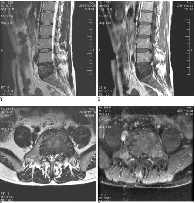 Fig. 1. MRI in 43-year-old man with brown tumor of the spine.