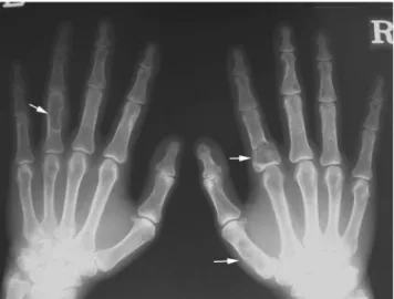 Fig. 2. Lateral view of lumbar spine shows relatively well de- de-fined osteolytic lesion in L5 body (arrow).