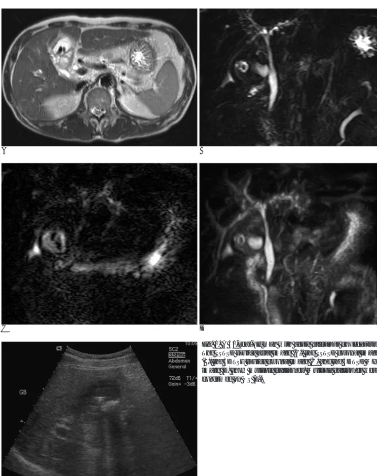 Fig. 1. A 51-year-old man with acute calculous cholecystitis.