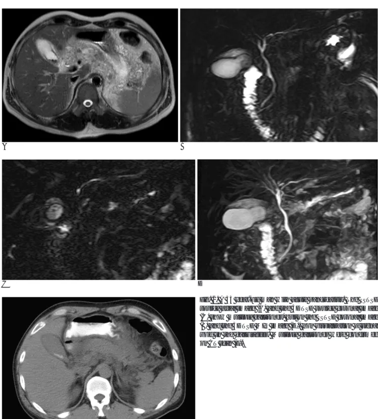 Fig. 2. A 33 year-old man with acute pancreatitis. The SSTSE source axial image (A) and the 3DTSE source coronal image (C) show multiple gallstones, but on the SSTSE coronal image (B) and the 3DTSE MIP image (D), non visualization of signal void in the gal