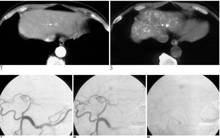 Fig. 1. Hypervascular hyperplastic nodule in a 55-year-old men with chronic alcoholic liver disease (Case 4).
