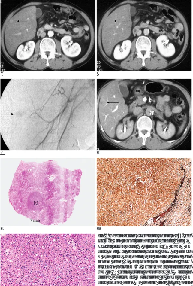 Fig. 2. Hypervascular hyperplastic nodule in a 56-year- 56-year-old men with chronic alcoholic liver disease (Case 5).