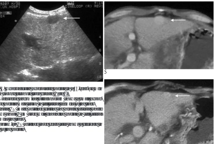 Fig. 3. Hypervascular hyperplastic nodule in a 53-year-old men with chronic alcoholic liver disease (Case 2).