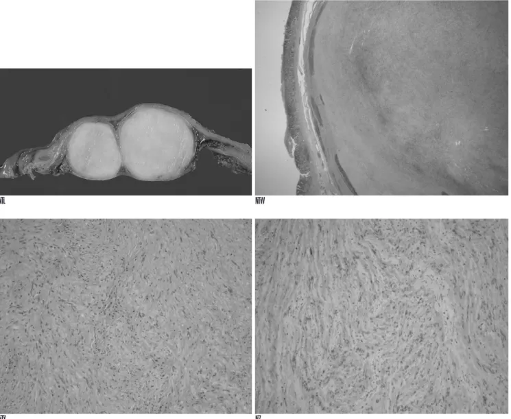 Fig. 1. E. Gross pathologic specimen of resected stomach shows well circumscribed, encapsulated intramural pale brown solid mass with bilobular appearance and intact overlying mucosa.