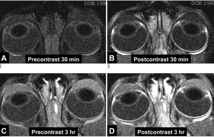 Fig. 2. T1-weighted (320/20/2) axial images of a cat in the experimental group. 30 minutes after embolization (A: precontrast, B: