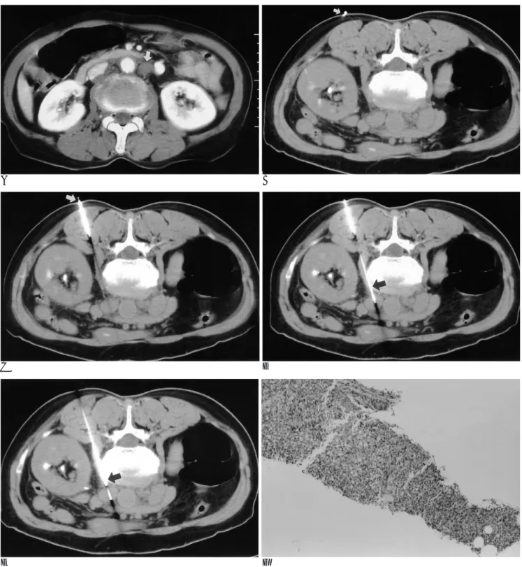 Fig. 1. Steps of modified coaxial technique in percutaneous CT-guided biopsy of a small paraaortic lymph node
