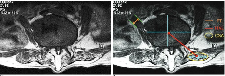 Table 2. Correlations between the Body Mass Index and the Cross-Sectional Area of the Erector Spinae Muscle, the Moment Arm Length of the Erector Spinae Muscle and the thickness of the Psoas Major Muscle in Both the LDK and Control Groups, According to Spe