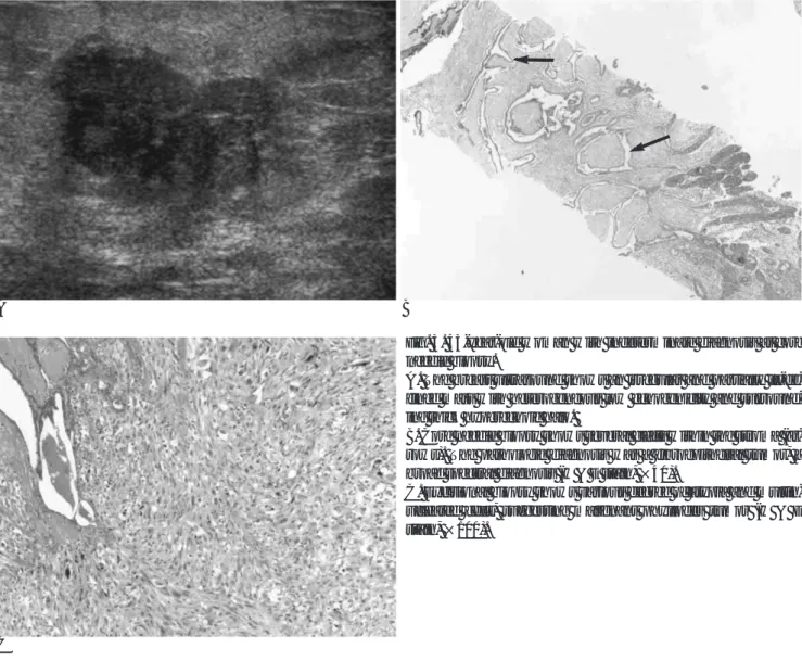 Fig. 3. 43-year-old woman with indeterminate diagnosis at core needle biopsy.