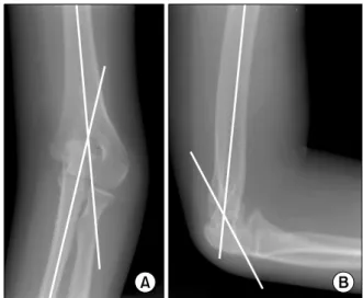 Fig.  1. (A) Lateral closing wedge osteotomy was performed.  (B) Lazy  'S'  deformity  was  observed  on  the  radiograph  of  two  months  after  the  operation.