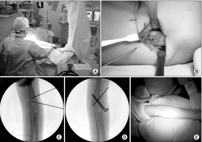 Fig.  3. (A) The angle of  cubitus  varus  deformity  was  measured intraoperatively  with  C-arm  fluoroscopy