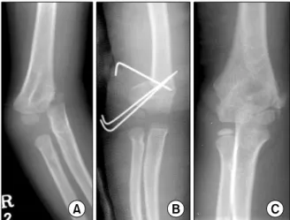 Table  2.  Factors  Associated  with  the  Remodeling  of  the  Lateral Prominence