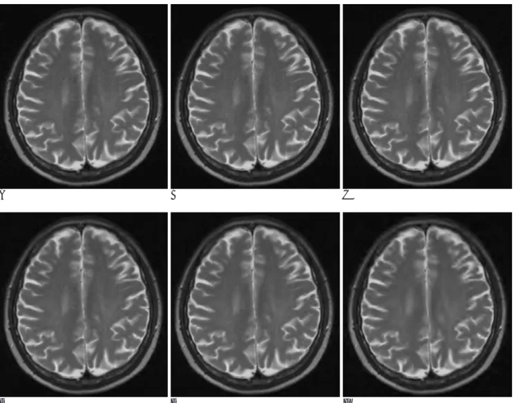 Fig. 1. A. Original DICOM brain MR image B. 5:1 compressed image