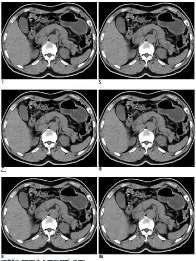 Fig. 2. A. Original DICOM abdominal CT image B. 5:1 compressed image