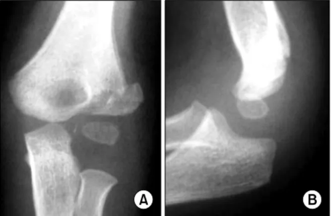 Fig.  2.  Postoperative  antero-posterior  (A)  &amp;  lateral  (B)  radiographs of  the  same  case
