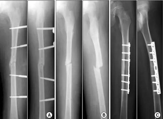 Fig.  2.  (A)  Postoperative  10  week  radiographs  in  a  9-year-  old  boy  treated  with  external  fixation  show  good  union