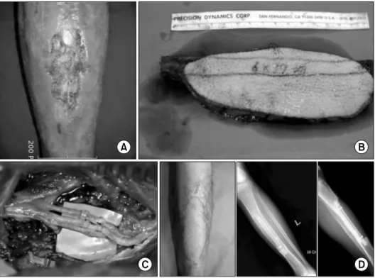 Fig.  2.  (A)  Chronic  tibial  osteo- osteo-myelitis with pretibial skin defect.
