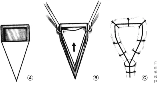 Fig.  1.  Standard  V-Y  advance- advance-ment  flap.  The  V-shaped   inci-sion  was  designed  so  that  the  resulting  stem  of  the  "Y"  will  lie  perpendicular  to  the  RSTL.지 않다면 국소, 피판술의 좋은 적응증이 될 수가 있다