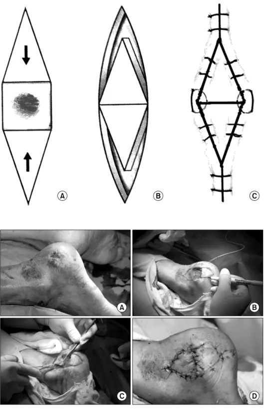 Fig.  2.  Souble  V-Y  advance- advance-ment flap. (A) Two V-shape flaps were  incised  on  the  opposing  sites of  the defect
