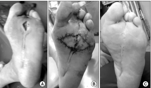 Fig.  4.  These  serial  clinical  pho- pho-tographs  show a  example of  the successful  healing  of  a  chronic  diabetic  foot ulcer that occurred 37 months earlierusing a double V-Y  advancement  flap.