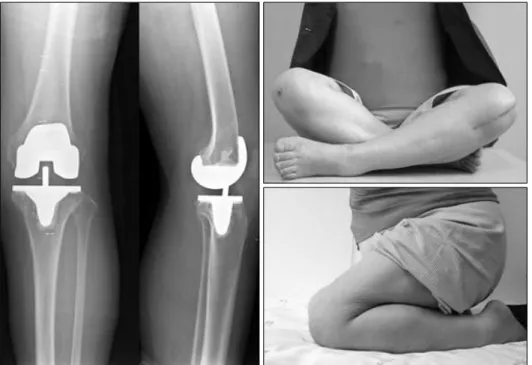 Fig.  4.  Full  flexion  angle  of  the  same  patient  is  145 o . Table  2.  Clinical  Results  according  to  Knee  Society  Score  (KSS),  Knee  Society  Functional  Score  (KSFS)  and  Visual  Analog  Scale  (VAS)
