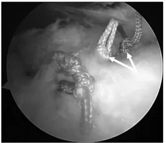 Fig.  3.  Two  sets  of  arthroscopic  modified  Mason-Allen  stitch  from  one anchor  is made,  which is the Massive Cuff Stitch  (MCS).