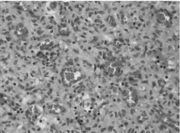 Fig. 2. Hematoxyllin and eosin-stained microscopic image (original magnification ×200) shows the capillary-sized spaces lined by monotonous endothelial cells in a collageneous  fi-brous stroma