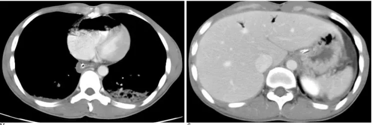 Fig. 2. A. CT scan obtained after intravenous contrast injection shows large quantity of air near completely replacing blood within right ventricle.