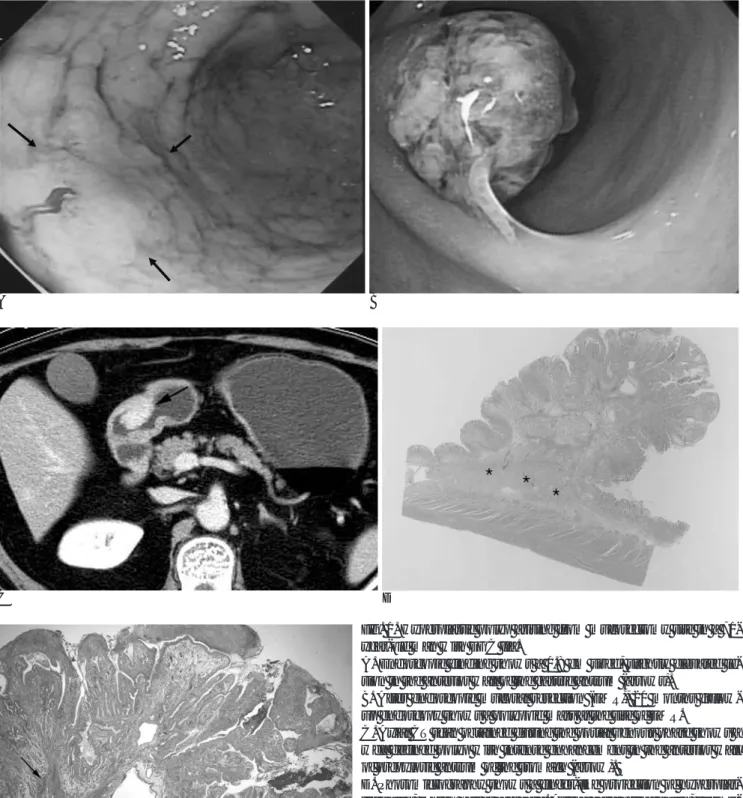 Fig. 1. Hyperplastic polyp arising from mucosectomy site in a 71- 71-year-old man with EGC IIa.
