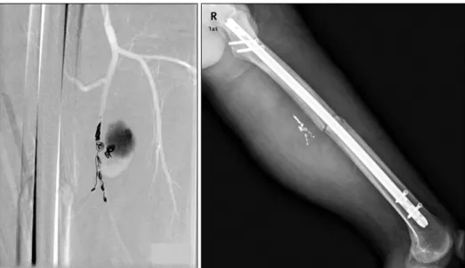 Fig.  4.  The  pseudoaneurysm  was  treated  by  radiologic   inter-vention with coil embolization in the  angiogram  and  simple  x-  rays