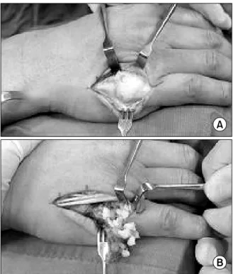 Fig.  3.  Intraoperative  clinical  photographs.  (A)  Approximately  a 3×2 cm sized  mass was exposed from the proximal third of  the 5th  metacarpal  bone  to  the  metacarpophalangeal  joint