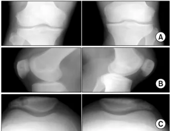 Fig.  2.  Sagittal  images  of  the  knee  MRI.  (A)  Sagittal  T1-weighted MRI  of  the  knee  demonstrating  a  multilobulated  intermediate  signal  intensity mass in the superolateral aspect of the patella