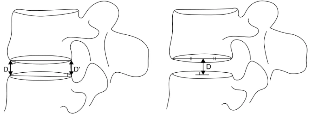 Fig.  1.  The  method  for  measuring  the  disc  height.  (A)  The  anteroposterior  disc  height  [(D+D')/2]  was  calculated  using  the  mean  value  of  D and D'