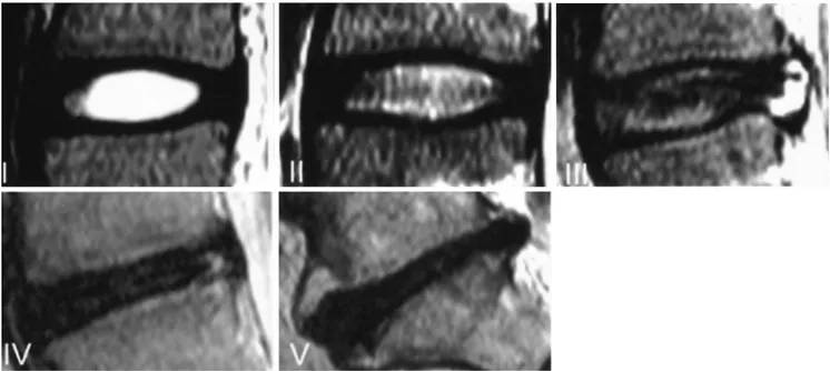 Fig. 2. I- V, Grade of the disc degeneration on the T2- weighted mid-sagittal image.