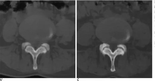 Fig. 5. A 38-year-old female patient with right central disc protrusion at the L4-5 disc level, and this patient  un-derwent PELD two months after the initial surgery