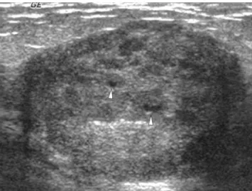 Fig. 3. A 27-year-old woman with complicated cysts.
