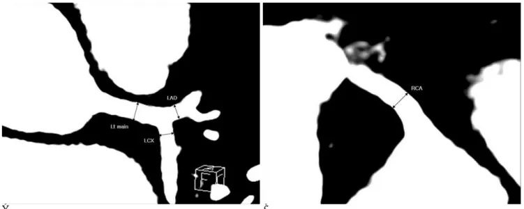 Fig. 2. Fixed-threshold vessel diameter method, which simulates shaded surface display