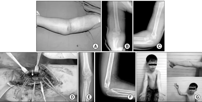 Fig.  1.  (A)  In  a  six-year-old  boy  presented  with  severe  swelling  of  right  upper  arm,  and  the  raidal  pulse  was  absent  in  the  emergency room