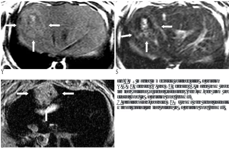 Fig. 1. MR imaging immediately obtained after RF ablation A, B. T1-weighted (A) and T2-weighted (B) images show three laminar patterns of signal intensities (high-low-high from the central zone) in RF ablation zone (arrows).