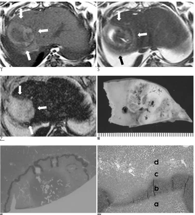 Fig. 2. MR imaging obtained 3 days after RF ablation