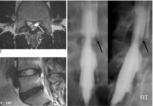 Fig. 3. 22-years-old man with low back pain. Axial (A) and sagittal (B) T2-weighted images show no disc herniation but represent a high signal-intensity mass adjacent to the right facet joint (white arrow) compressing the thecal sac at the L4-L5 interspace