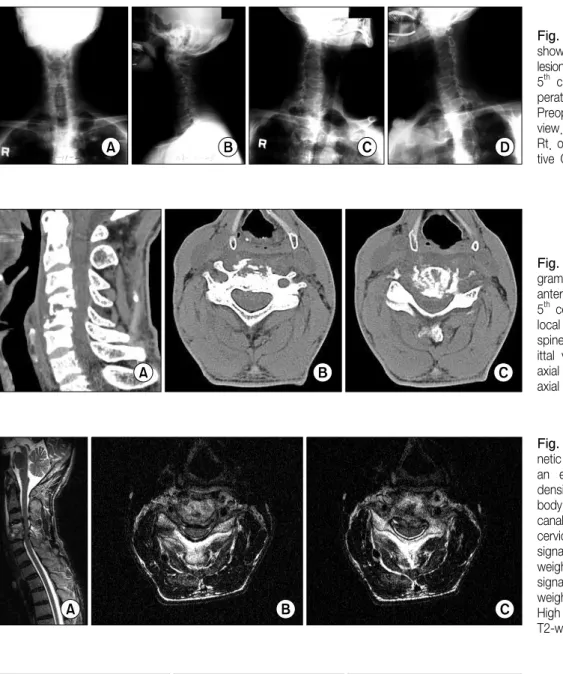 Fig.  1.  The  plain  radiograph  shows  a  ground  glass  pattern  lesion of  the body of  the 4 th   and 5 th   cervical  vertebra