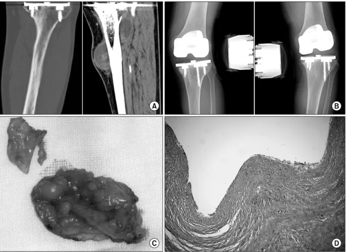 Fig.  1. (A) The CT  image  of a knee  of a 71-year-old female  showing  a  cyst  communicating  with  the  screw  hole  of  the  tibia  component.