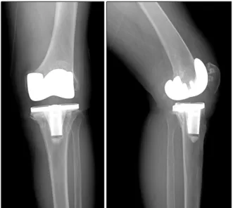 Fig.  2.  Cemented  total  knee  revision  arthroplasty  was  performed.
