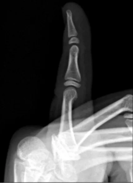 Fig.  2.  A  volarly  displaced  proximal  epiphysis  was  reduced  satisfactory  in  the  lateral  C-arm  view.